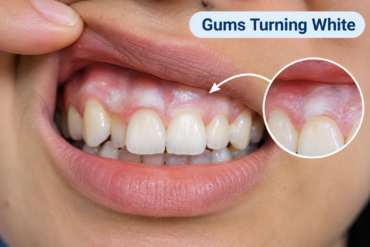 gums turning white